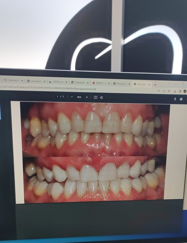 caso-clinico-blanqueamiento