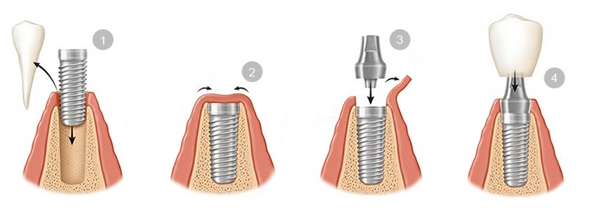 ¿Cómo se realiza el procedimiento de colocación de los implantes dentales?
