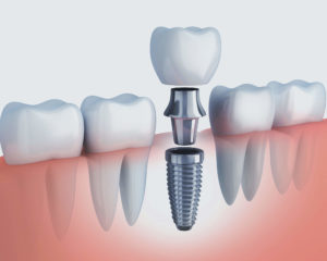 ¿Qué es realmente un implante y cuales son sus beneficios?