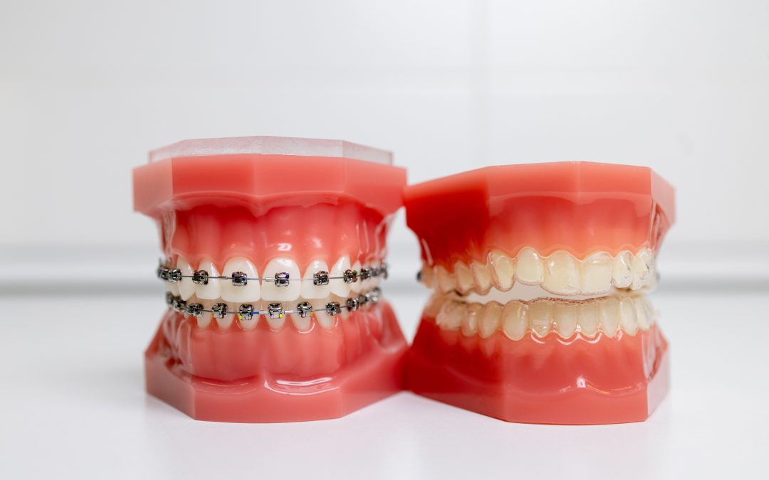 Ortodoncia tradicional tipo brackets vs ortodoncia transparente Invisalign