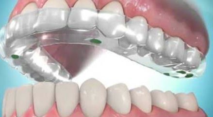 Férula Descarga. ¿Qué es y para que se utiliza?