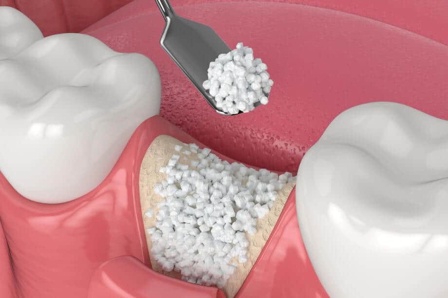 Injerto de Hueso Dental. Todo lo que necesitas saber.