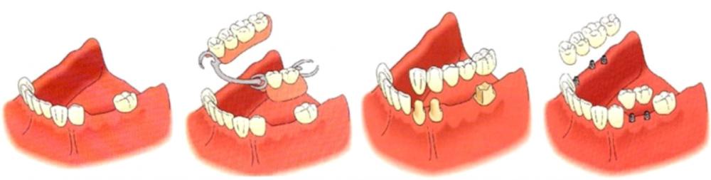 Tipos de prótesis dentales.