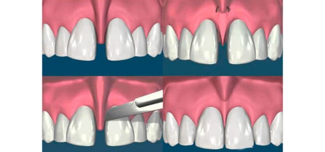 FRENECTOMIA. ¿QUÉ ES?