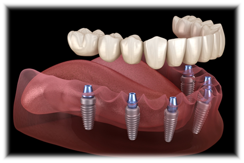 Prótesis sobre implantes