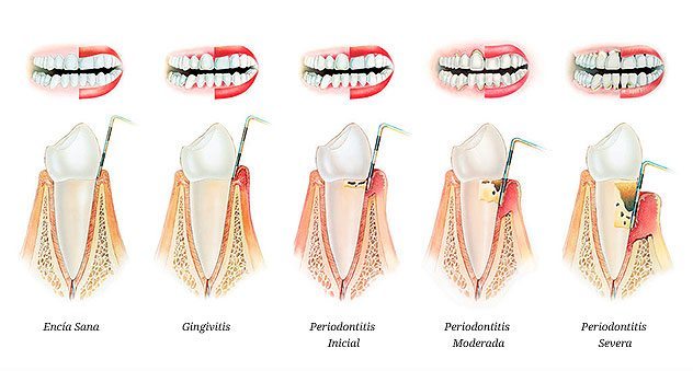 LA PERIODONCIA: LA CLAVE PARA QUE TU SONRISA DURE (Y SOBRETODO SEA SANA)
