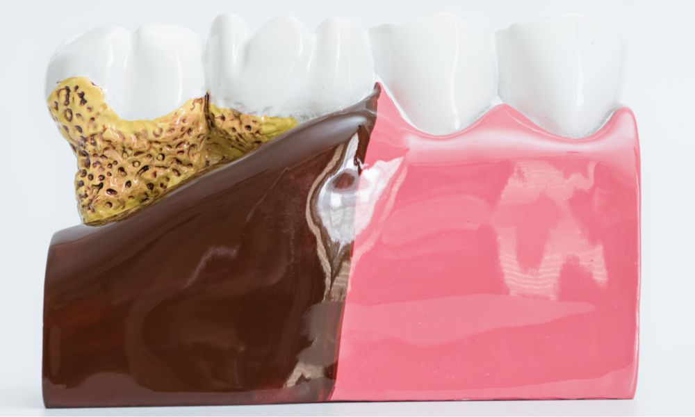 Bolsas periodontales y recesión gingival: causas, consecuencias y soluciones