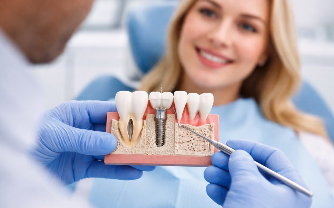 ¿Se pueden poner implantes dentales sin hueso? Opciones y soluciones en Jerez de la Frontera